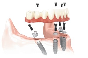 All on four treatment concept illustration