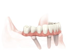 All on four dental implants in place